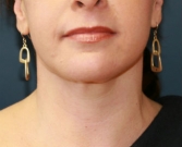 Feel Beautiful - Liposuction Neck San Diego Case 11 - After Photo